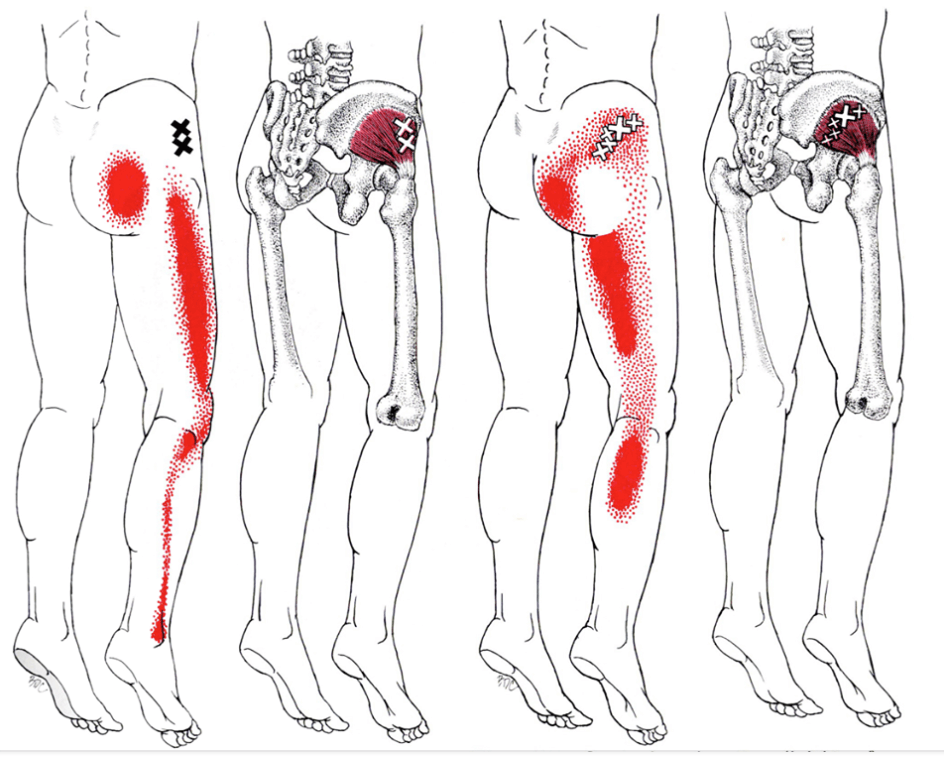 Gluteal referral pattern thumbnail