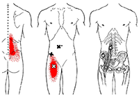 Psoas referral pattern thumbnail