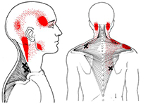 Upper trapezius referral pattern thumbnail